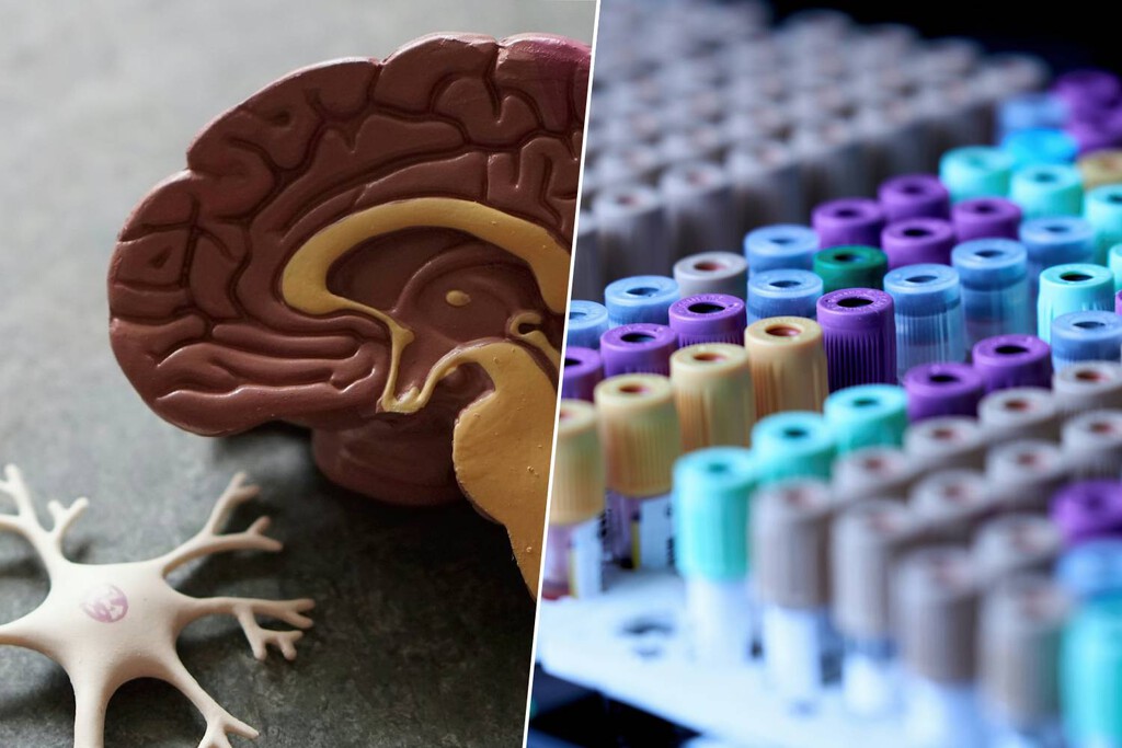 Avances en la detección temprana del Alzheimer: Un análisis de sangre predice el riesgo una década antes