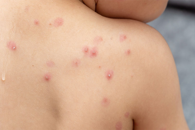 Mpox en República Dominicana: Guía Completa sobre la Enfermedad