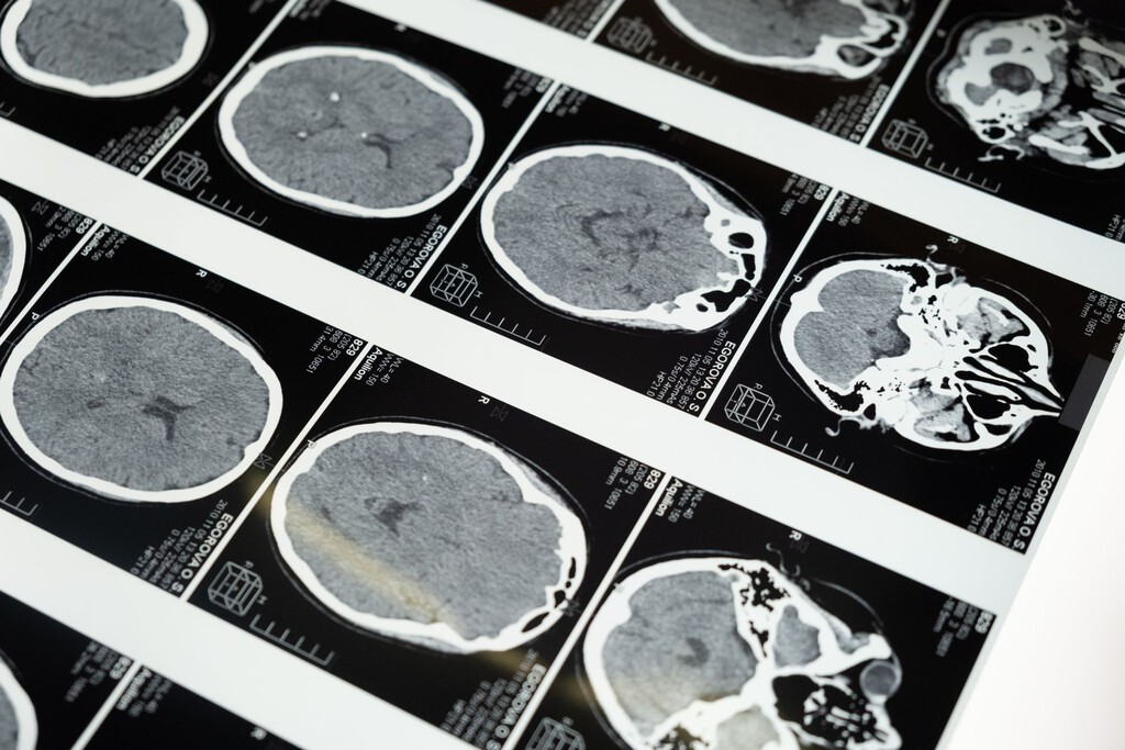 La mala salud metabólica acelera el envejecimiento cerebral a través de una vía independiente a la edad cronológica